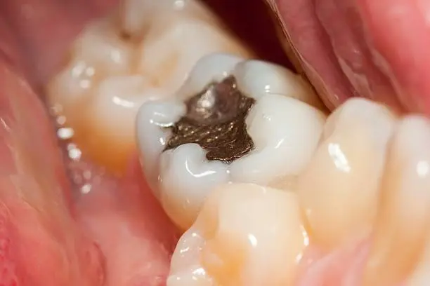 Amalgam Fillings in a tooth image